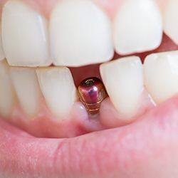 Dental implant in Reynoldsburg, OH in a healthy smile