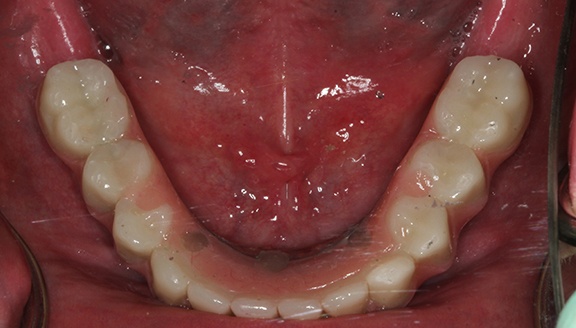 dentures patient 6 after
