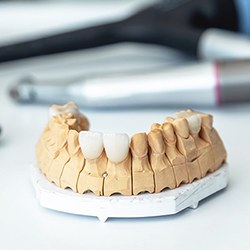 Model of beautiful dental implants in Reynoldsburg 