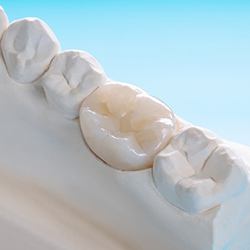 Closeup of beautiful, custom-made dental implant