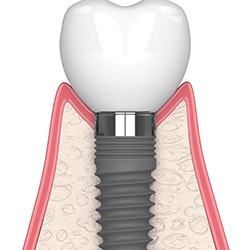 Illustration of a single dental implant in Reynoldsburg, OH