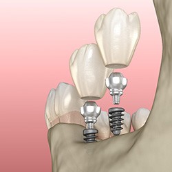 Illustration of mini dental implants in Reynoldsburg, OH